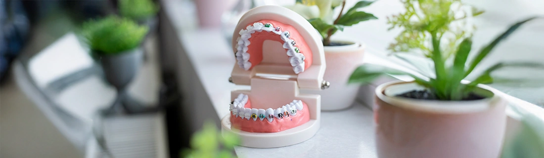 Dental Braces at York Dental in Parma Heights OH – FC Dental Braces at York Dental in Parma Heights OH – FC