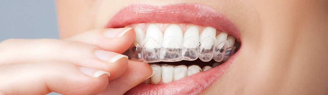 How Clear Aligners in Parma Heights OH Work: A Step-by-Step Guide to Your New Smile